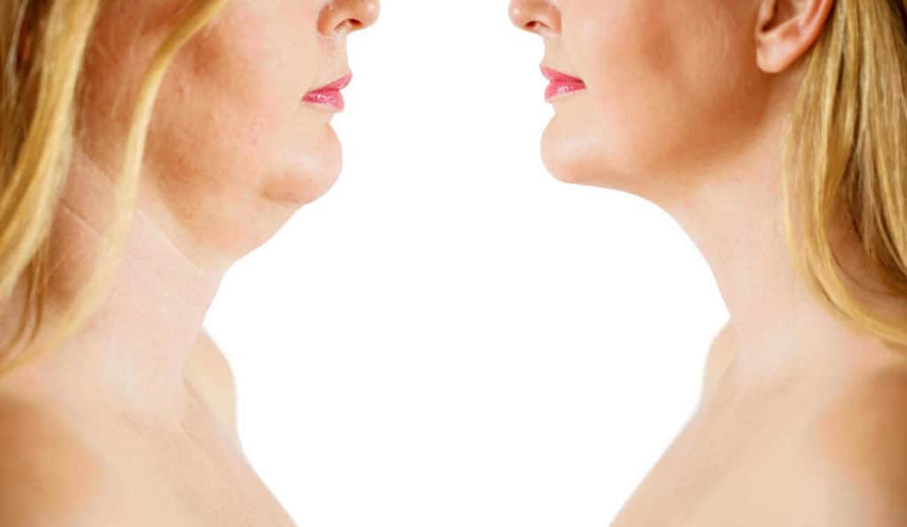 Double Chin treatment Sands End before and after results