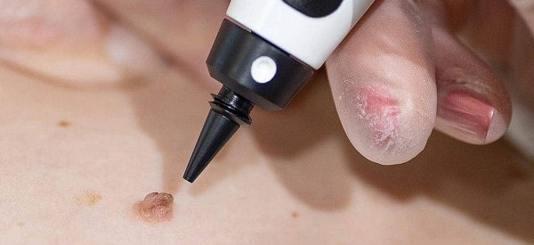 After Skin Tag Removal Sands End