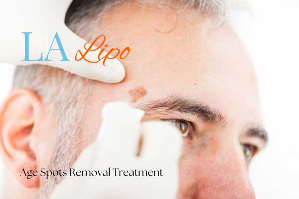 What Are the Most Effective Treatments for Age Spots Sands End?