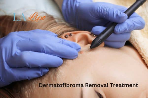 Dermatofibroma Removal Treatment Sands End
