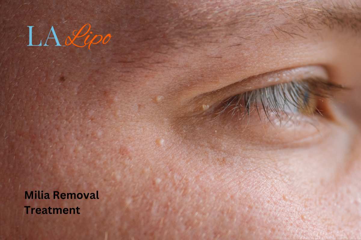 Cryopen Milia Removal: Is It the Easiest and Safest Option Sands End?