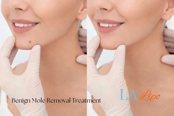 Before-and-after results following benign mole-removal treatment Sands End
