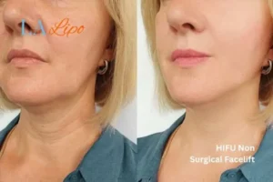 hi-fu for wrinkles Sands End before and after results
