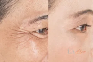 Before and after results of woman - HI-fu wrinkles reduction treatment Sands End