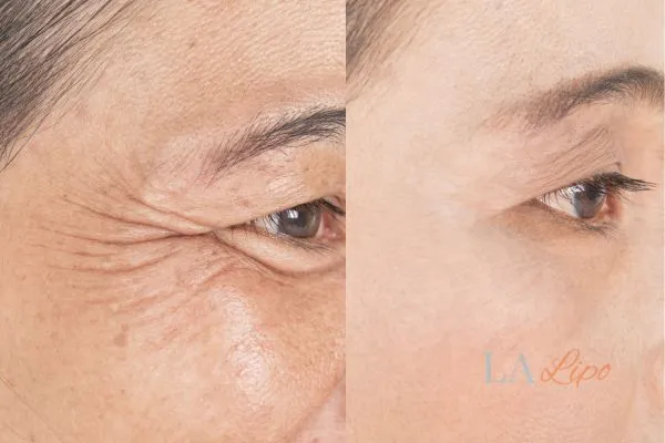 Before and after results of woman - HI-fu wrinkles reduction treatment Sands End