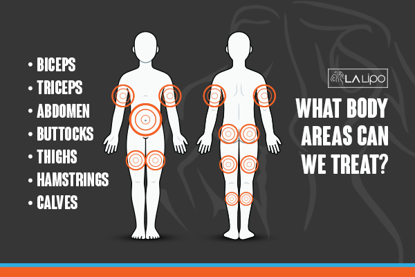 Graphic to show areas you can have LA-EMS Body Sculpting Sands End treatment.