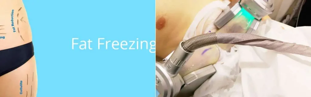 multi areas of a persons body having coolsculpting Sands End treatment