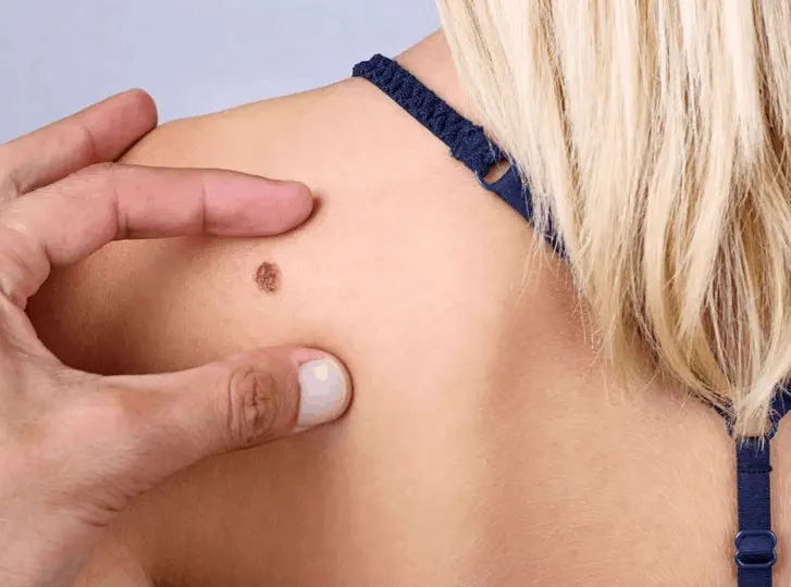 woman having mole removal Sands End consultation before treatment.
