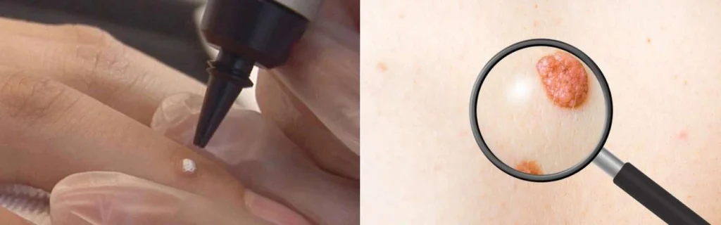 CryoPen practitioner Sands End assessing a benign mole before treatment