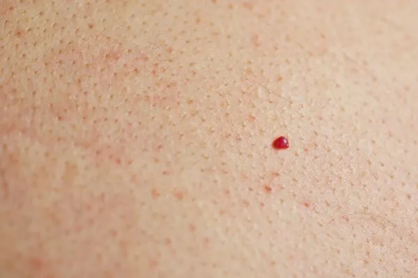 close up of a cherry angioma Sands End