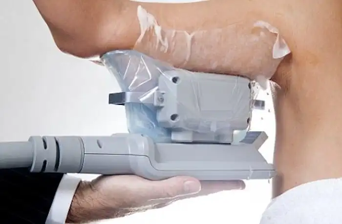 Picture of fat freezing Sands End on the upper arms.