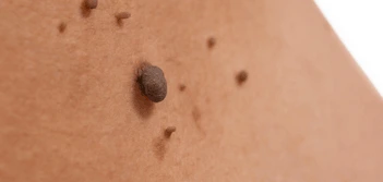 image of a skin tag Sands End