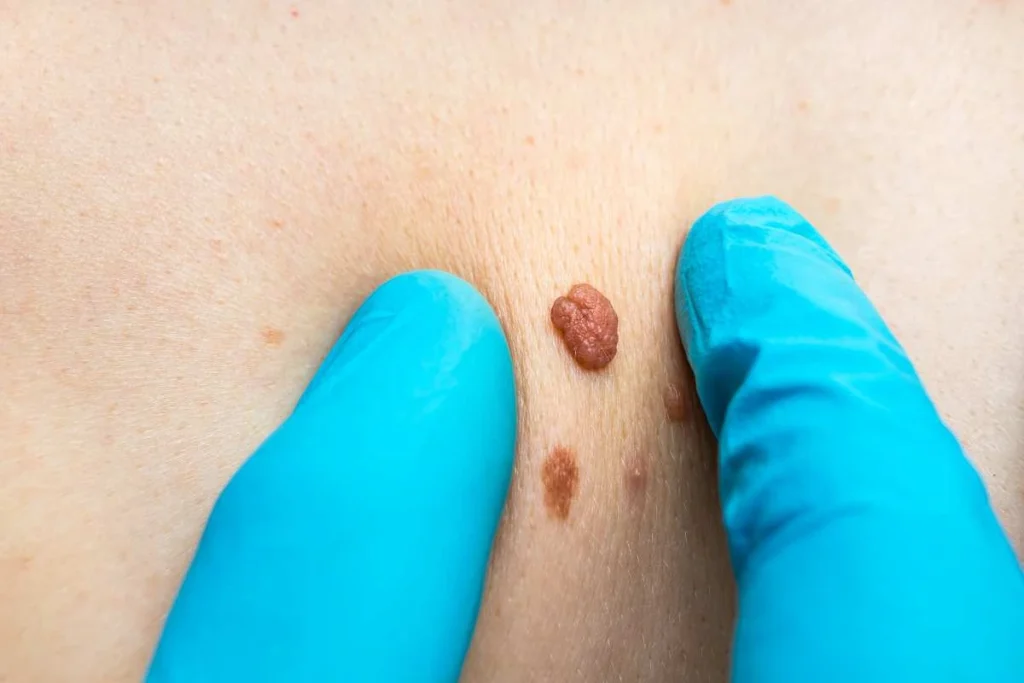 Consultant examining a skin tag Sands End