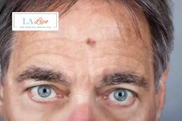Solar Lentigo Removal Sands End image of man with mark on his forehead