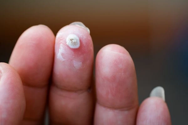 wart on person finger - cryotherapy to treat from LA LIPO Sands End
