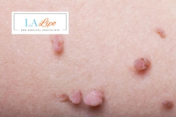 Does cryopen skin tag removal Sands End hurt? Find out now call our team today!