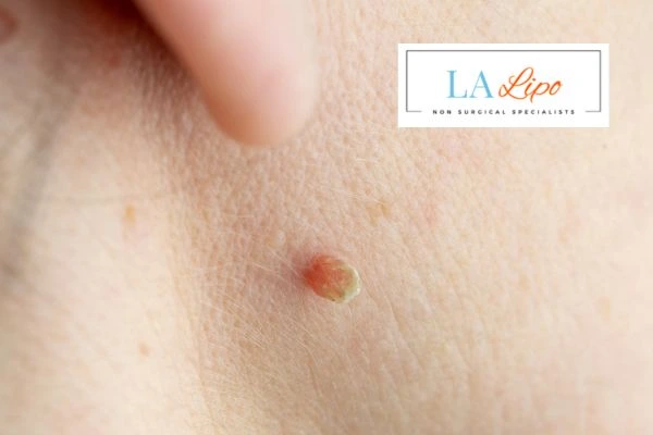 Book skin tag removal Sands End today speak to our team now!