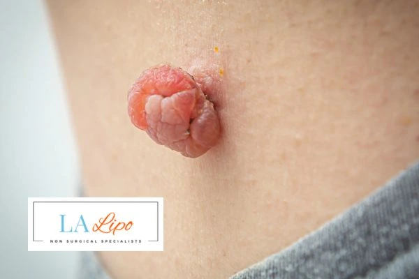 Interested in skin tag removal Sands End? Concerned about the pain? Find out more today!