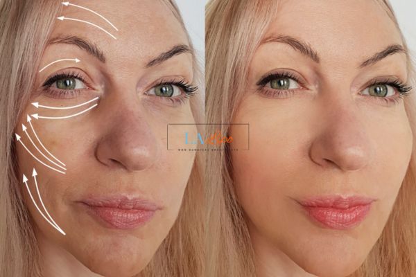 Morpheus 8 results Sands End face lift.