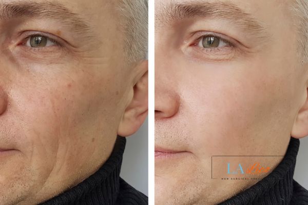 See the amazing results of Morpheus8 Treatment Sands End!