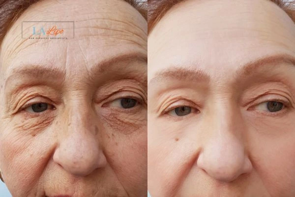 The powerful benefits of Morpheus8 Treatment Sands End - Call Our team today!