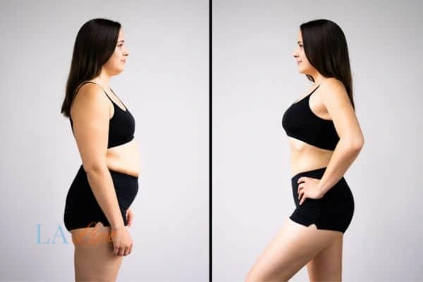 Picture of womans before and after using LA-EMS body sculpting to improve her core strength Sands End