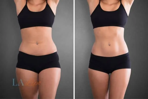 before and after results of non-surgical treatment to help a woman's body image and mental health Sands End
