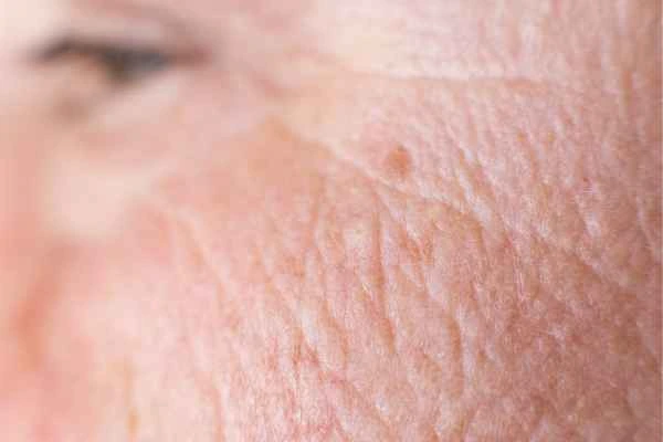 close up picture of a woman's face showing an age spot Sands End