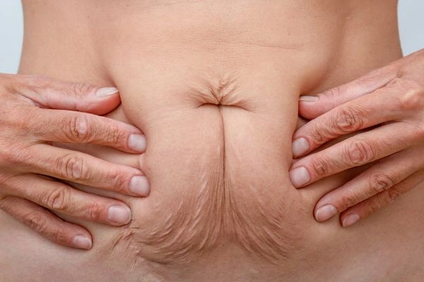 Image of a woman's stomach with loose skin - example of skin tightening Sands End options
