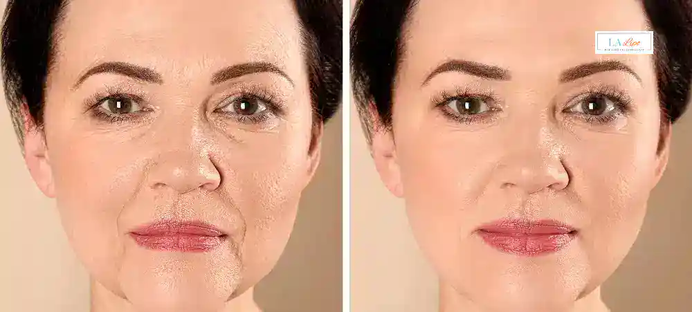 How Long Does It Take to See Results and How Long Do They Last Sands End?