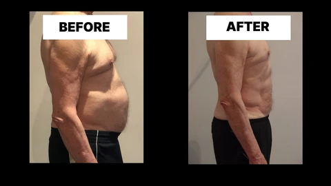What Symptoms Can Diastasis Recti Cause in Men? Weak Core, Back Pain and Poor Posture Sands End